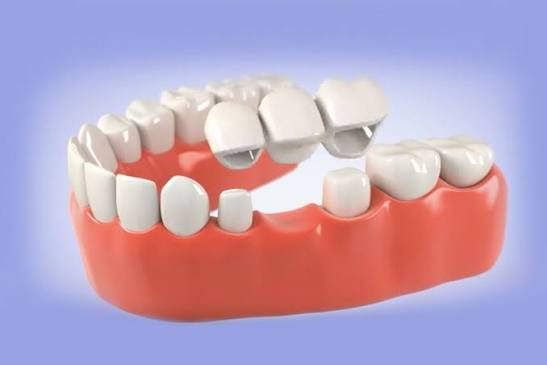 Dental crowns and bridges treatment