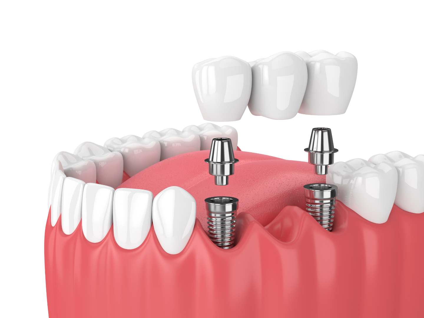 Dental implant treatment in a modern clinic