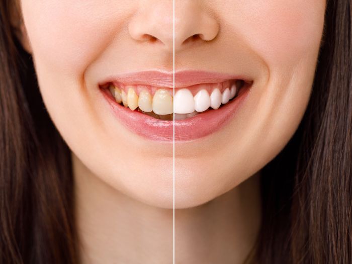 Teeth whitening treatment for a brighter smile