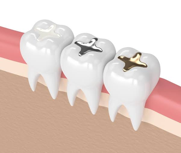 Tooth-coloured fillings treatment