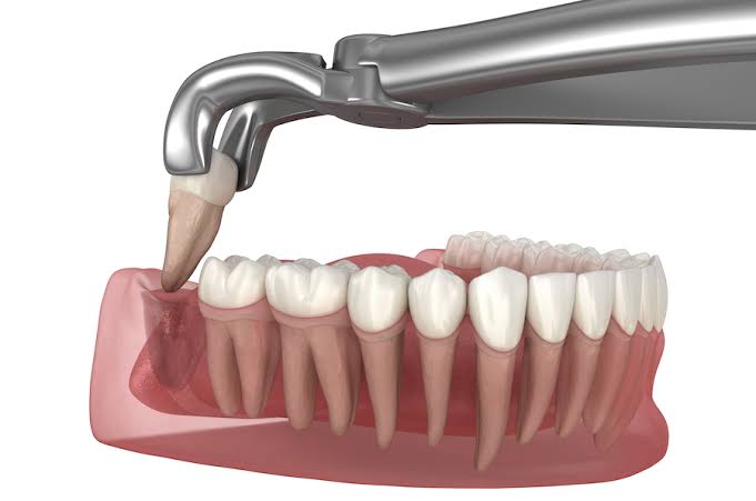 Wisdom tooth extraction treatment